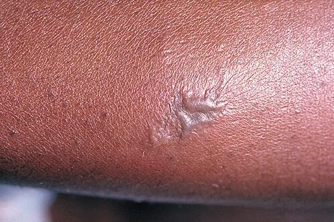 gonorrhea: a sexually transmitted infection caused by Neisseria gonorrhoeae, a species of bacteria (the...