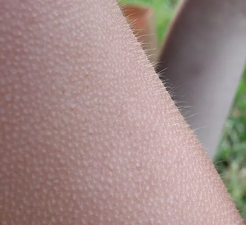 goose bump: raised skin, usually caused by the involuntary erection of hairs on the neck or arms caused by...