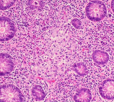 granuloma: an inflammatory nodule consisting of histiocytes (macrophages) attempting to wall off substances...