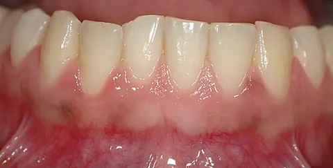 gum: the flesh around the teeth