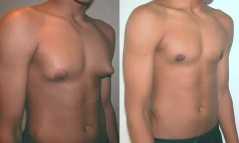 gynecomastia: excessive development of breasts in men, resembling the breast development in women