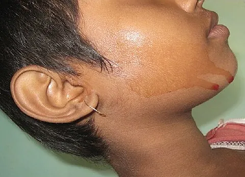 haematidrosis: a very rare disorder in which the patient sweats blood and/or blood pigments, usually resulting...