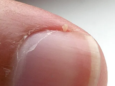 hangnail: a loose, narrow strip of nail tissue protruding from the side edge and anchored near the base of a...