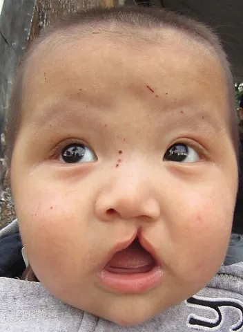 harelip: a congenital malformation of the upper lip, reminiscent of the mouth of a hare