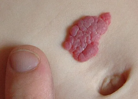 hemangioma: a usually benign vascular tumor derived from endothelial cells