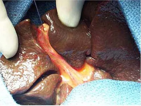 hepatoportoenterostomy: a portoenteric reconstruction in which the obliterated extrahepatic biliary tree is excised and a...