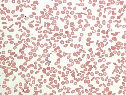 hereditary elliptocytosis: an inherited blood disorder in which, through a membrane defect, an abnormally large number of...
