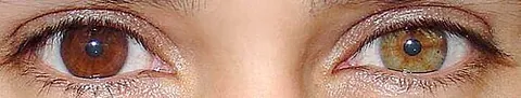 heterochromia: an anatomical condition in which multiple pigmentations or colorings occur in the eyes, skin or hair