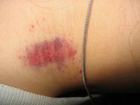 hickey: a bruise-like mark made during petting by pressing the mouth to the skin on one’s partner’s body...
