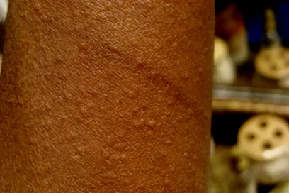 hives: itchy, swollen, red areas of the skin which can appear quickly in response to an allergen or due to...