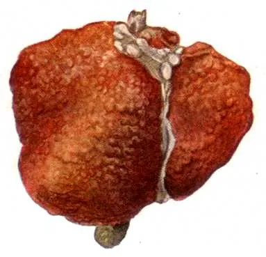hobnail liver: a shrunken liver, hard, and covered with hobnail-like projections (nodules), resulting from...