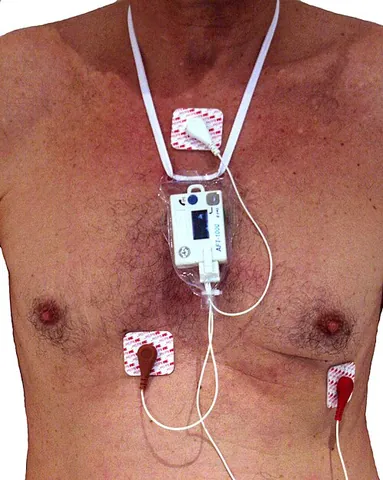 holter monitor: a portable device for continuously monitoring the electrical activity of the heart, usually for 24...