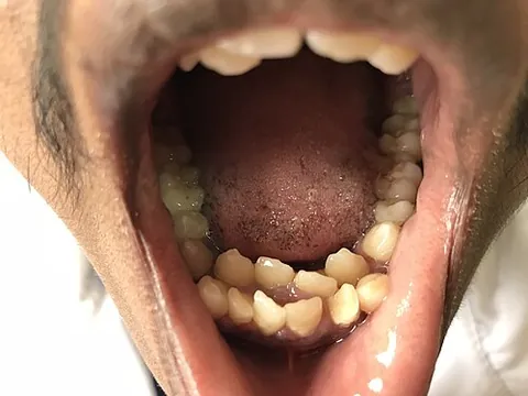 hyperdontia: the condition of having teeth that appear in addition to the regular number of teeth