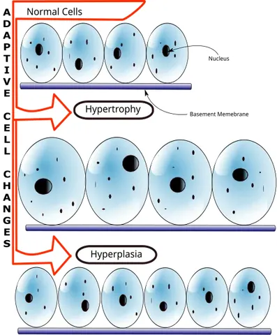hypertrophy: an increase in the size of an organ or tissue due to the enlargement of its individual cells