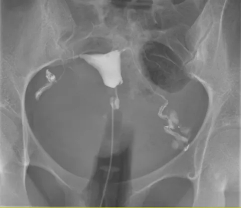 hysterosalpingography: an X-ray test that uses contrast dye to examine the uterus and fallopian tubes, mainly to check...