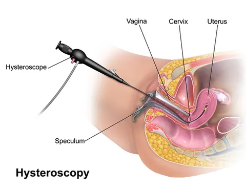 hysteroscopy: a medical procedure where a doctor uses a thin, lighted camera inserted through the vagina and...