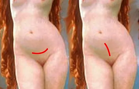 hysterotomy: the surgical procedure of making an incision in the uterus, commonly combined with a laparotomy...