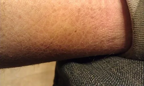 ichthyosis vulgaris: a genetic skin disorder causing dry, scaly skin