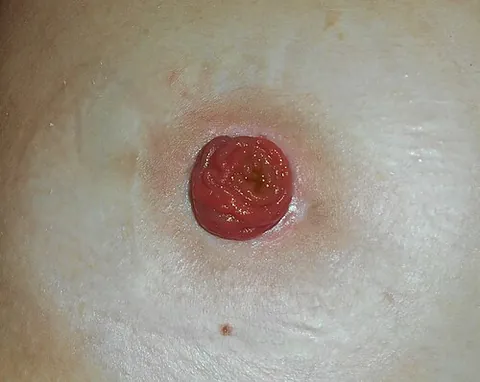 ileostomy: the surgical operation of attaching the ileum to the abdominal wall at a stoma (similar to a...