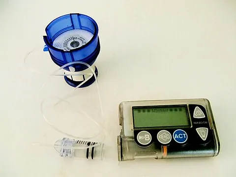 insulin pump: a medical device used for the administration of insulin relying on a motor