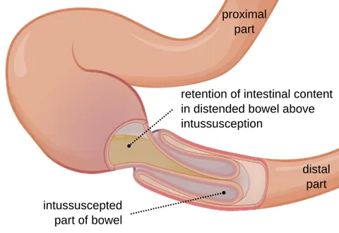intussusception: the invagination of one portion of a tubular anatomical structure (especially intestines or blood...