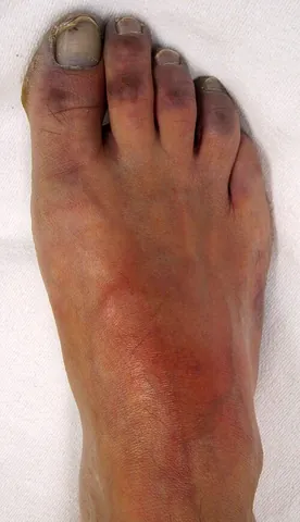 ischemia: local disturbance in blood circulation due to mechanical obstruction of the blood supply (for...