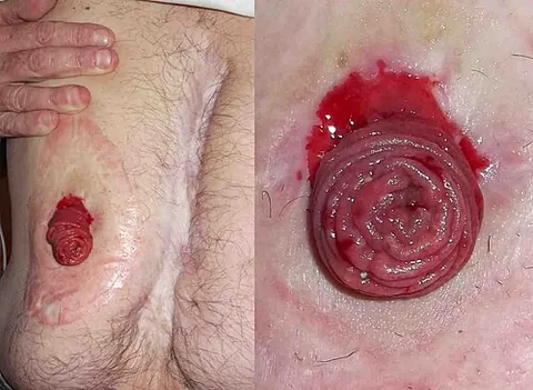 jejunostomy: a surgical procedure in which a tube or opening is created directly into the jejunum
