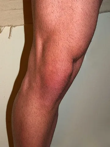 knee: in humans, the joint or the region of the joint in the middle part of the leg between the thigh and...