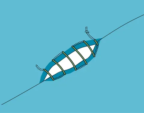 ladder stitch: a stitch used to close seams, in which the thread runs through alternating lengths of both sides