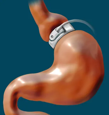 lap band: an inflatable silicone ring implanted around the upper stomach to treat obesity by decreasing food...