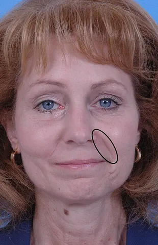laugh line: either of the two skin folds that run from each side of the nose to the corners of the mouth