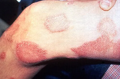 leprous: of or relating to one of the diseases known as leprosy