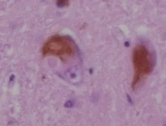 lewy body: an abnormal aggregate of protein that develops inside nerve cells