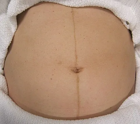linea nigra: a dark vertical line, running up the abdomen from the pubis to the navel (though it sometimes runs...