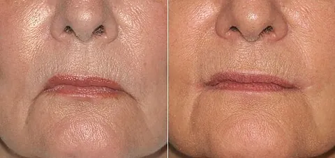 lip job: a plastic surgical procedure to alter the appearance of the lip(s), especially for cosmetic reasons