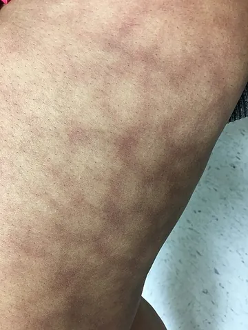 livedo reticularis: a purplish mottling of the skin usually seen in infants and young children, but occasionally...