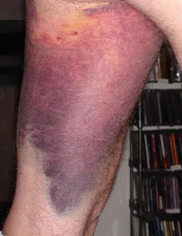 livid: having a dark, bluish appearance