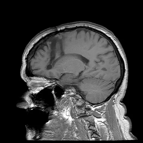 lobotomy: a surgical operation involving cutting into a lobe of a body organ, specifically (neurosurgery), a...