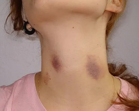 love bite: a bruise on the skin caused by someone sucking or biting it, usually with sexual intent