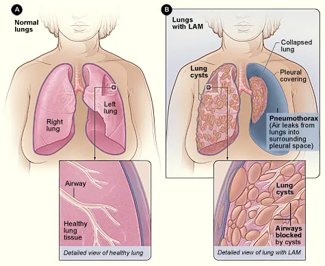 lymphangioleiomyomatosis: a rare, progressive disease in which abnormal smooth musclelike cells grow in the lungs and...