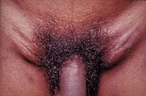 lymphogranuloma venereum: a sexually transmitted disease caused by Chlamydia trachomatis