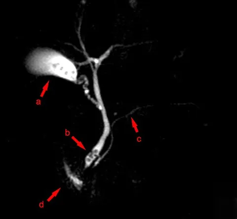 magnetic resonance cholangiopancreatography: a non-invasive MRI-based diagnostic technique used to visualize the bile ducts, pancreatic duct,...