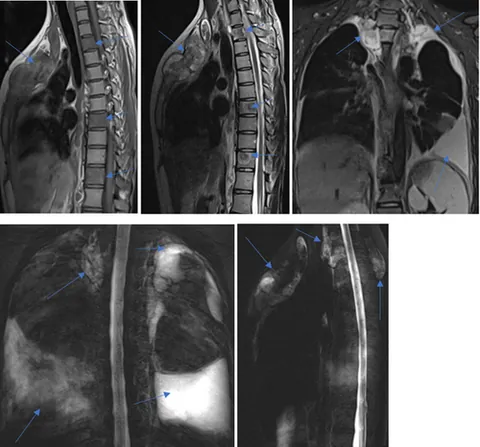 magnetic resonance myelography: a noninvasive magnetic resonance imaging technique that provides information about the subarachnoid...