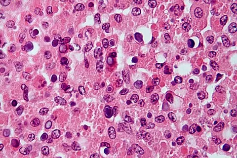 malakoplakia: inflammation of the mucous membrane of a hollow organ (as the urinary bladder) characterized by the...