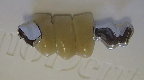 maryland bridge: a dental prosthetic replacing a missing tooth by a bridging piece which is glued to the backs of...