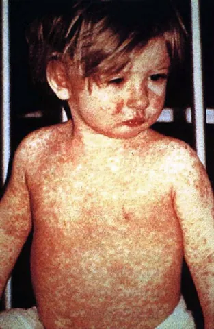 measly: particularly of pigs or pork: infected with larval tapeworms or trichinae (parasitic roundworms)