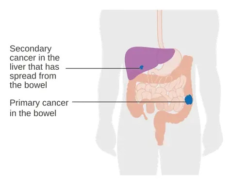 metastasize: of a disease (especially cancer) or a tumour: to form a metastasis (“a secondary focus away from...