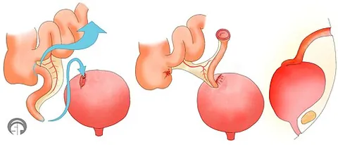 mitrofanoff procedure: a surgical procedure that creates a catheterizable channel between the bladder and the abdominal...