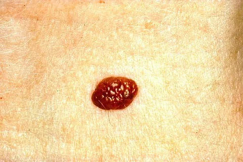 mole: a naevus, a pigmented, slightly raised, and sometimes hairy spot on the skin