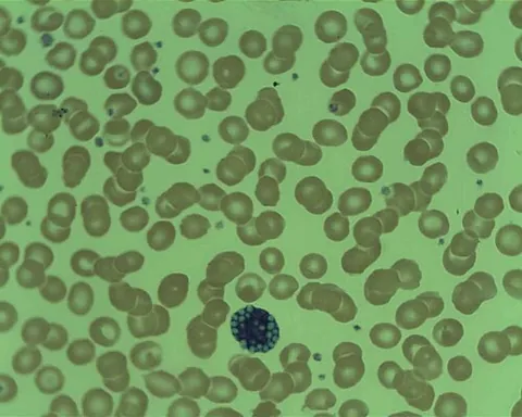 mott cell: an atypical plasma cell that has spherical inclusions filled with immunoglobulin (small Russell...